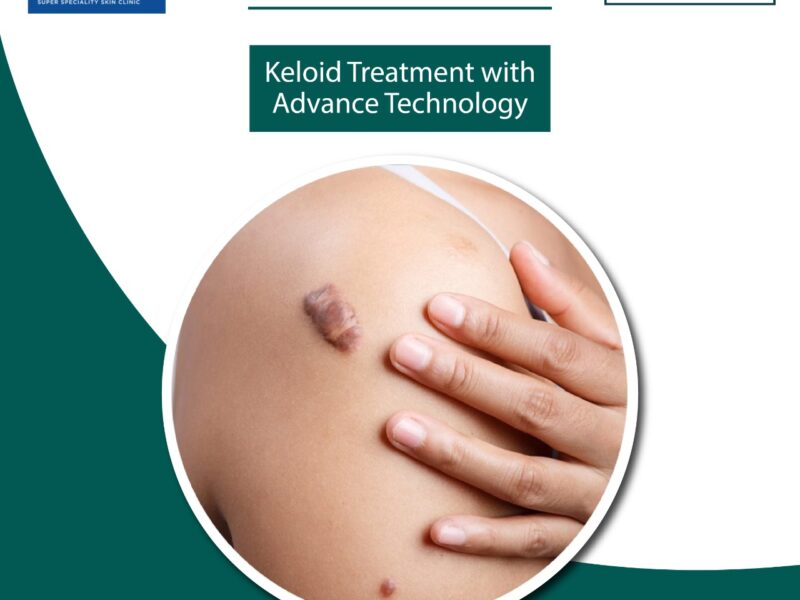 Keloid Specialist in Camp, Pune