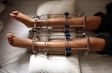Best Height Increase Surgeon in Delhi for Expert Limb Lengthening Care