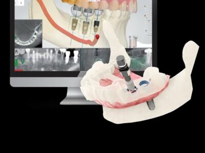 Shining 3D Intraoral Scanner | Digital Impression Scanner – DIO