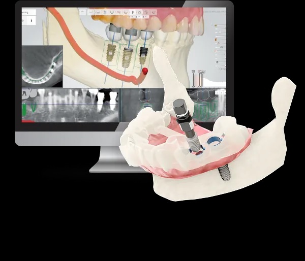 Shining 3D Intraoral Scanner | Digital Impression Scanner – DIO
